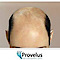 Hair Transplant Clinic Delhi